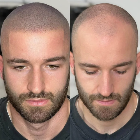 Historique de la tricopigmentation Évolution technique tricopigmentation
