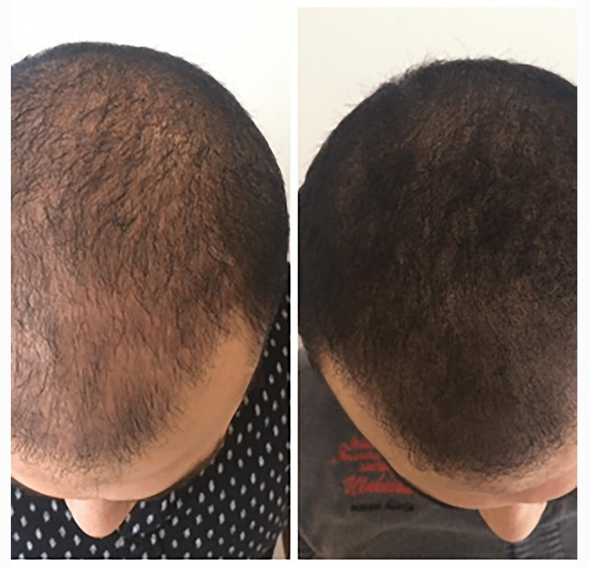 Tricopigmentation patients Pour qui est la tricopigmentation ?
